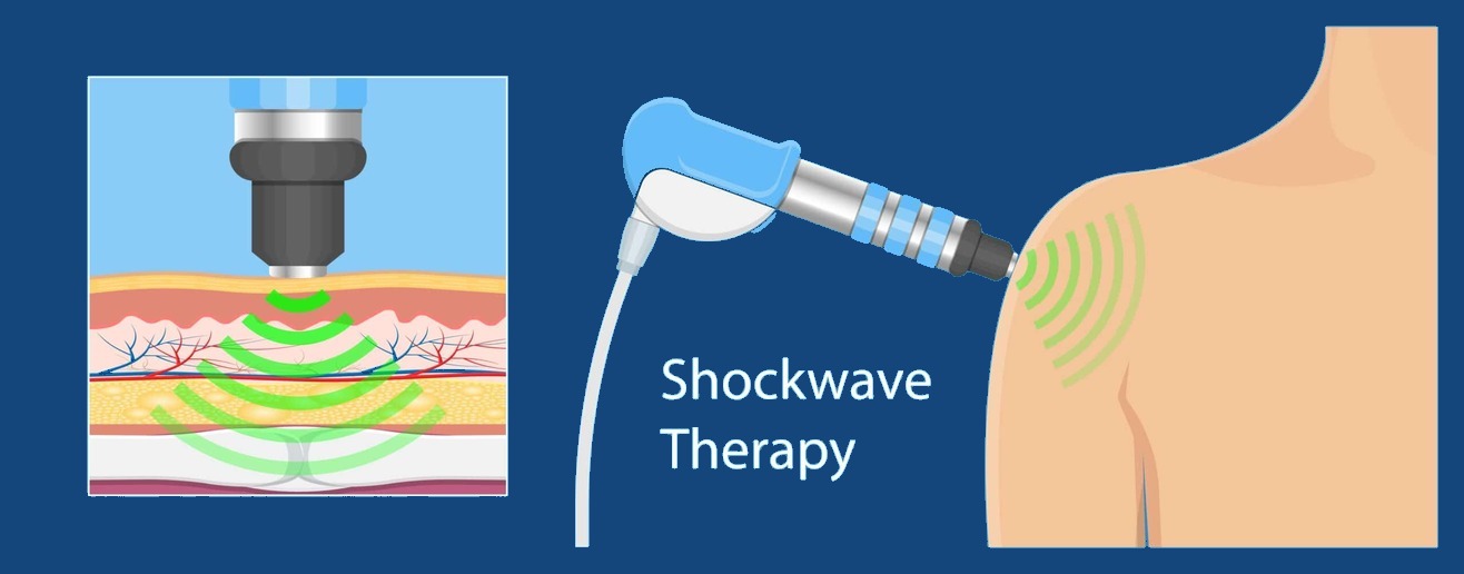 Shockwave-therapy