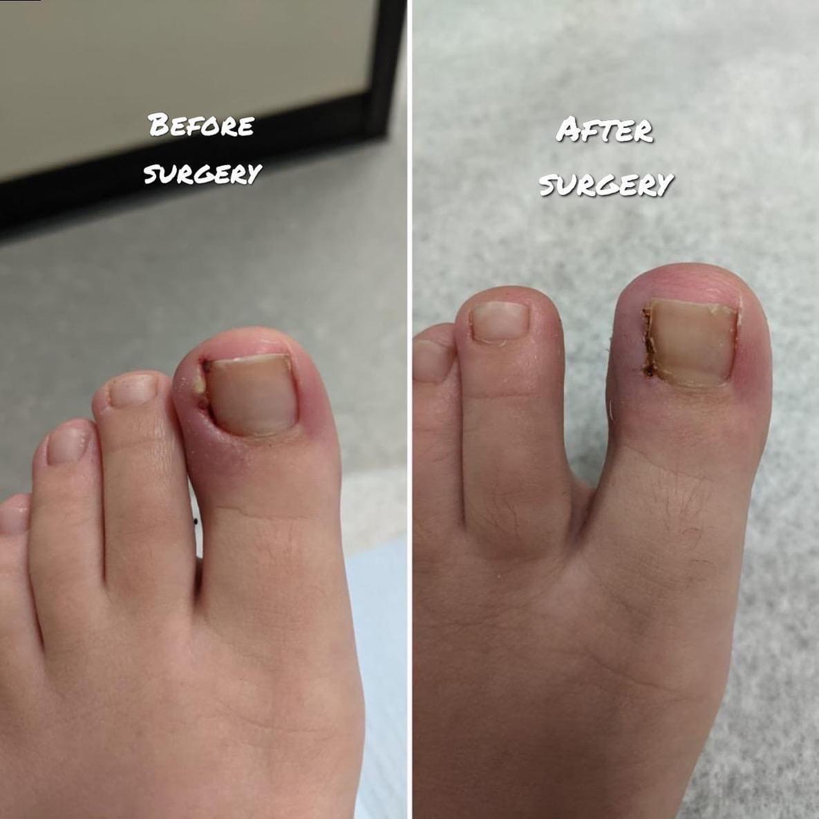 Ingrown Nail